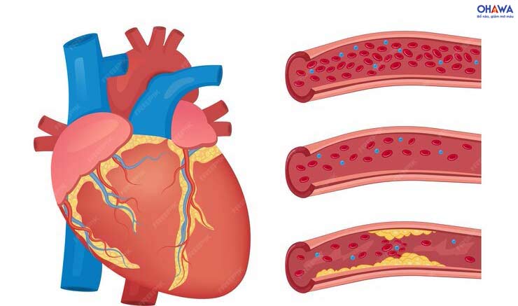 Cholesterol cao - Nguyên nhân gây xơ vữa động mạch