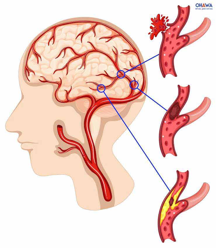Thiếu máu cục bộ - dấu hiệu của xơ vữa động mạch cảnh