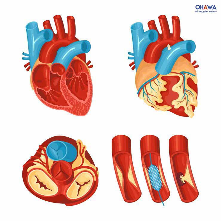 Hình thành vệt mỡ (xơ vữa) động mạch